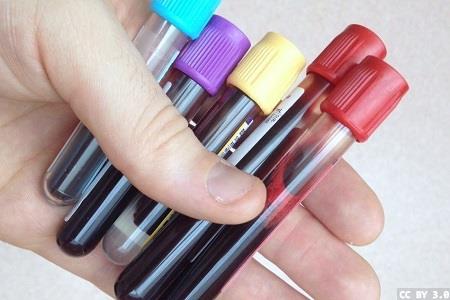 Galleri cancer test: comment from BIVDA