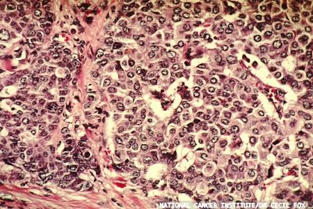 Improving breast cancer diagnosis with AI in pathology