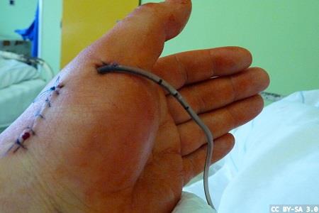 Surgical site infection: a time to act