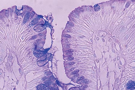 Barrett’s metaplasia: subtyping, stem cells and receptors