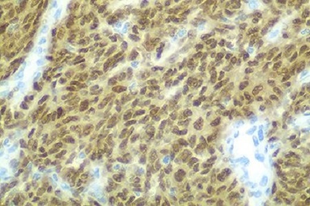 New test for the detection of synovial sarcoma
