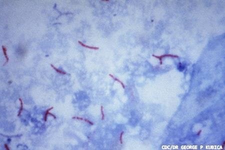 Antibiotic could be repurposed and added to tuberculosis treatment  