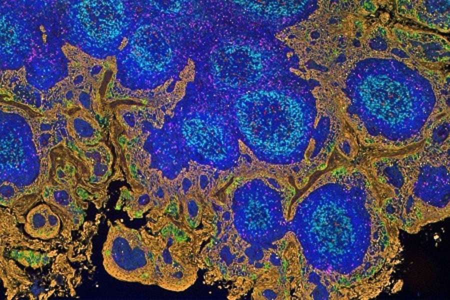 Immunophenotyping microfluidic technology for tumour profiling