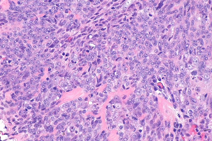 Investment in HPV biomarker immunoassay