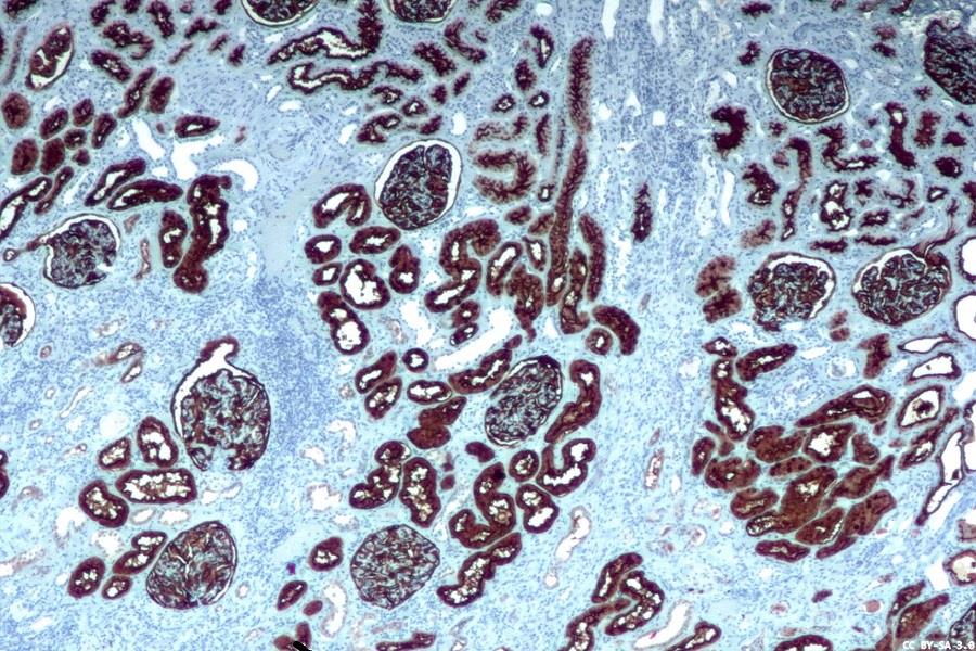 Updated CAP draft IHC guideline open for comment