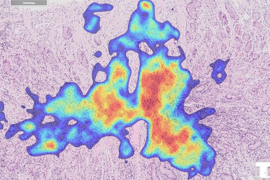 First AI-powered solution for gastrointestinal cancer diagnostics