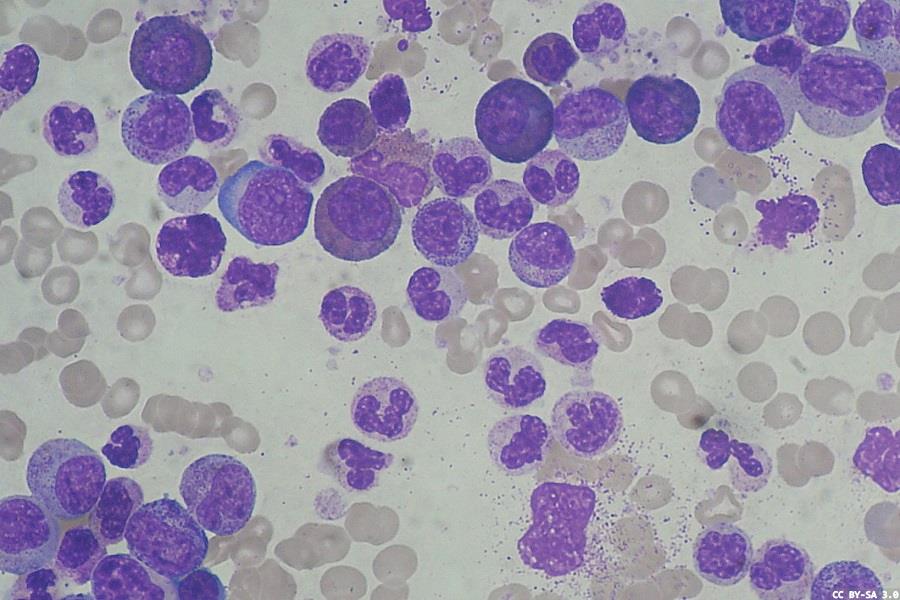 New cancer inhibitor could lead to improved treatment options in CML