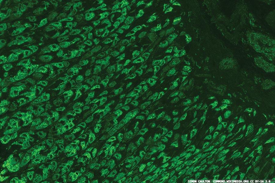 Pernicious anaemia: testing, staging and advances in genetics