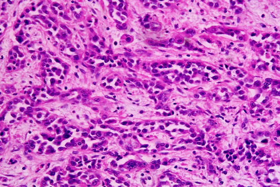 Results of AI-based pathology diagnostic tool for gastric cancer