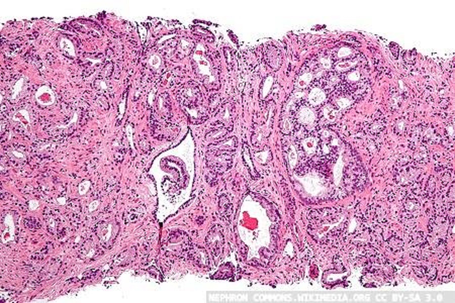 New and promising target against prostate cancer