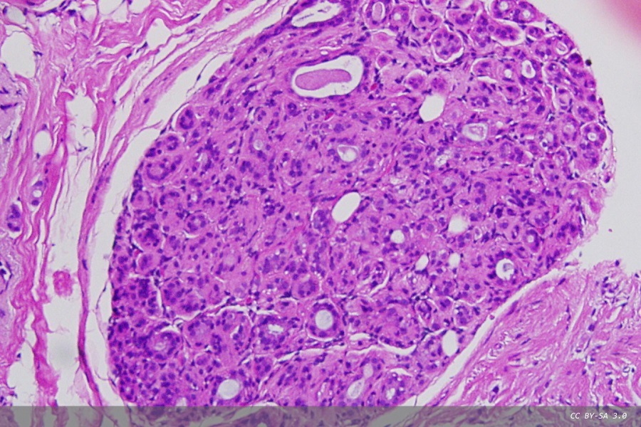 Spatial proteomics technology predicts breast cancer progression