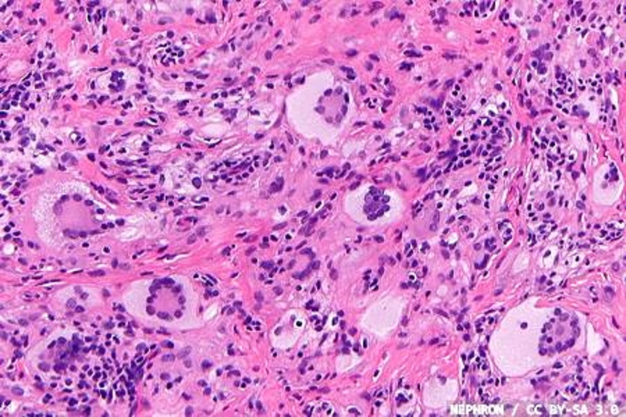 Full-scale digital pathology adoption at Uppsala University Hospital