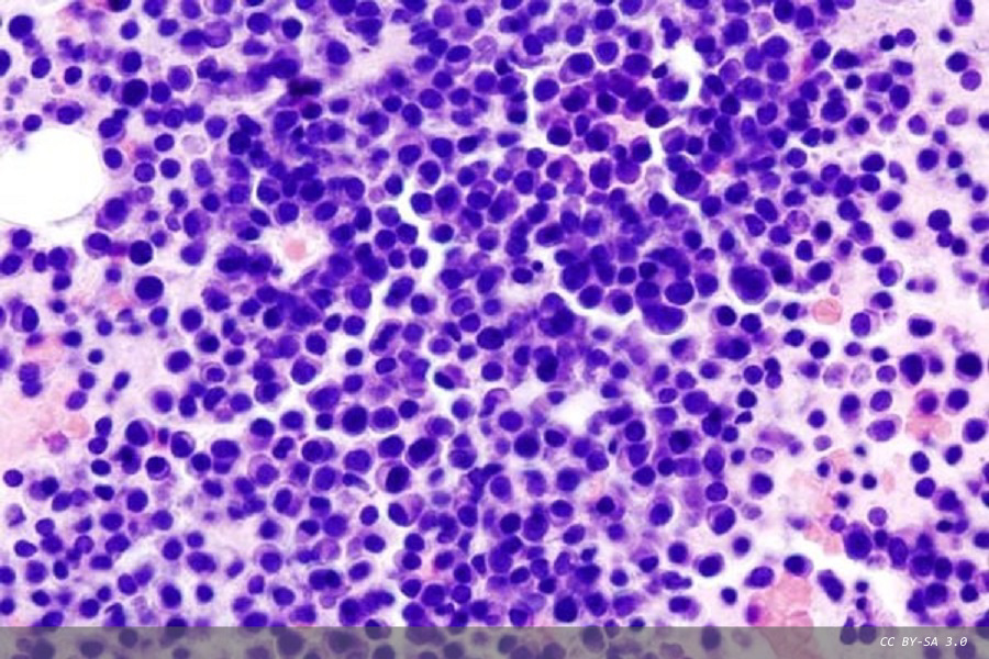 Introducing anti-daratumumab antibodies