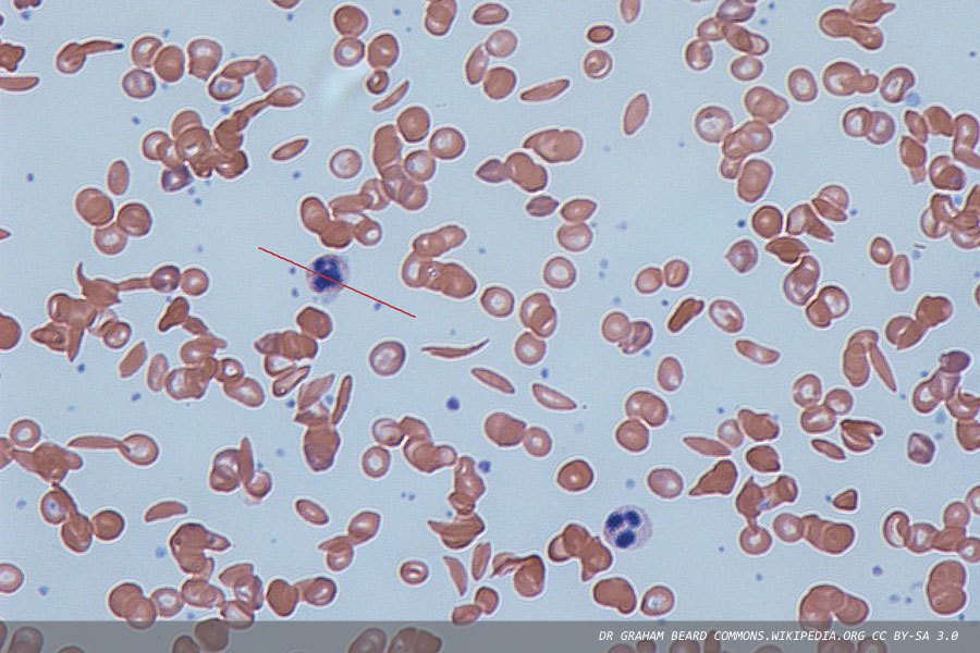 Sickle cell disease: papers with a genetic focus in the literature