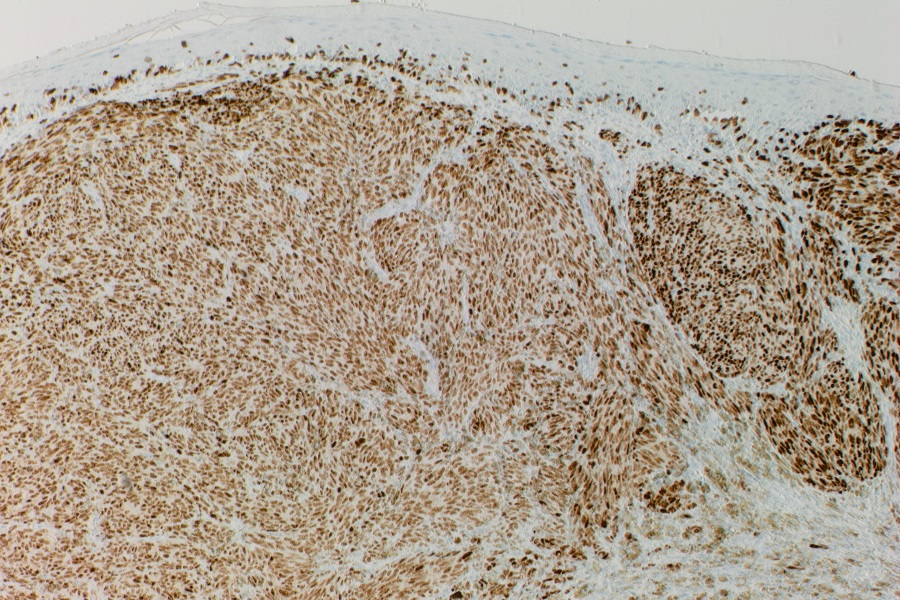 Expression of PRAME  in melanocytic lesions: significance and evaluation 