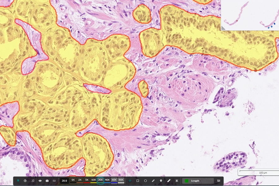 Certification for AI-based prostate cancer detection and Gleason grading tool