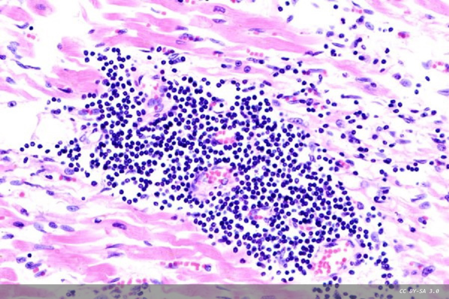 Heart Inflammation in 1 in 8 hospital patients with COVID-19