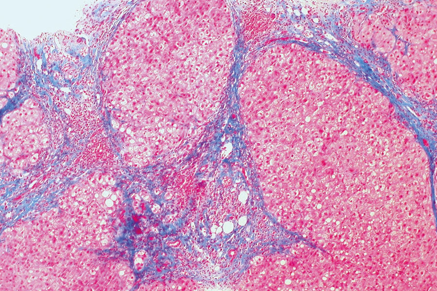 New liver fibrosis marker  for psoriasis patients on  methotrexate