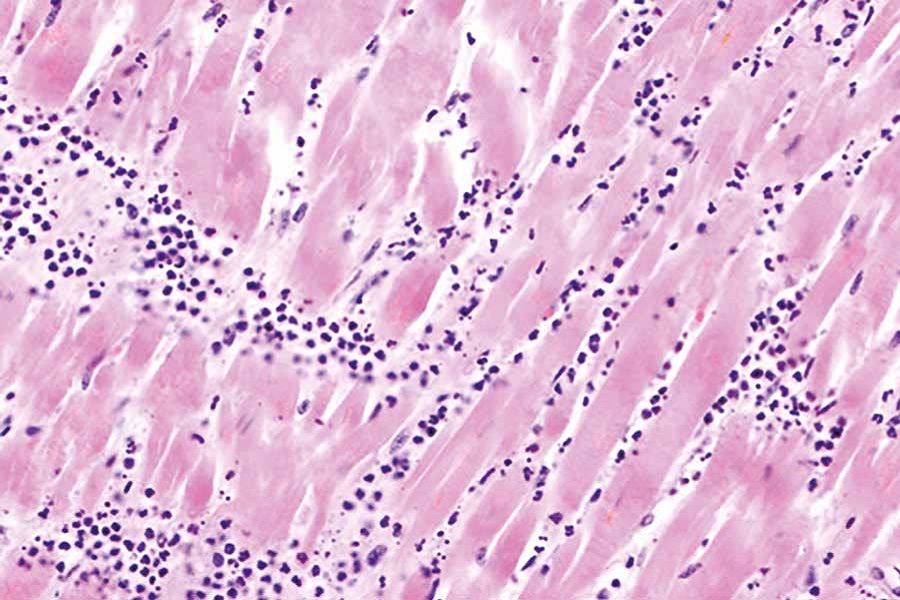 High-sensitivity troponin:  bringing testing to the  point of patient care