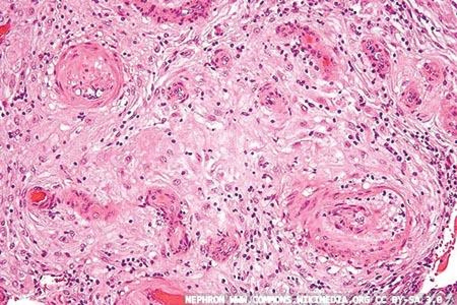 Testing to help diagnose pre-eclampsia recommended by NICE
