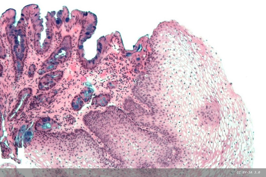Risk stratification of patients with non-dysplastic Barrett’s oesophagus