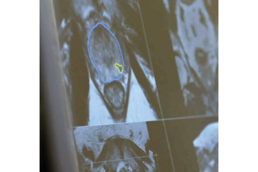 Zürich University Hospital starts using Stockholm3