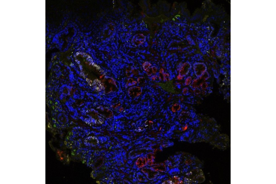 TissueCypher Barrett’s Esophagus Test can improve outcomes for patients with low-grade dysplasia