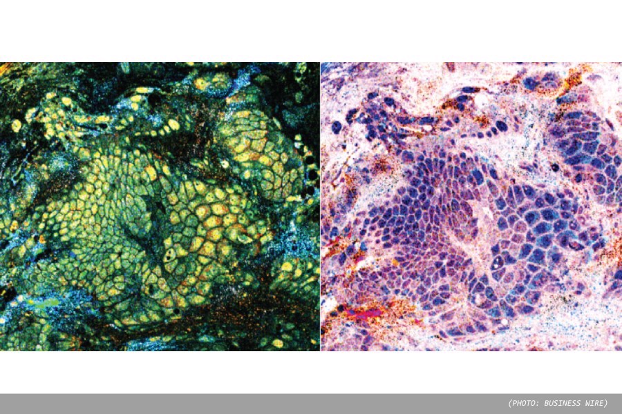 Aquyre Biosciences reaches procedure milestone during Lung Cancer Awareness Month
