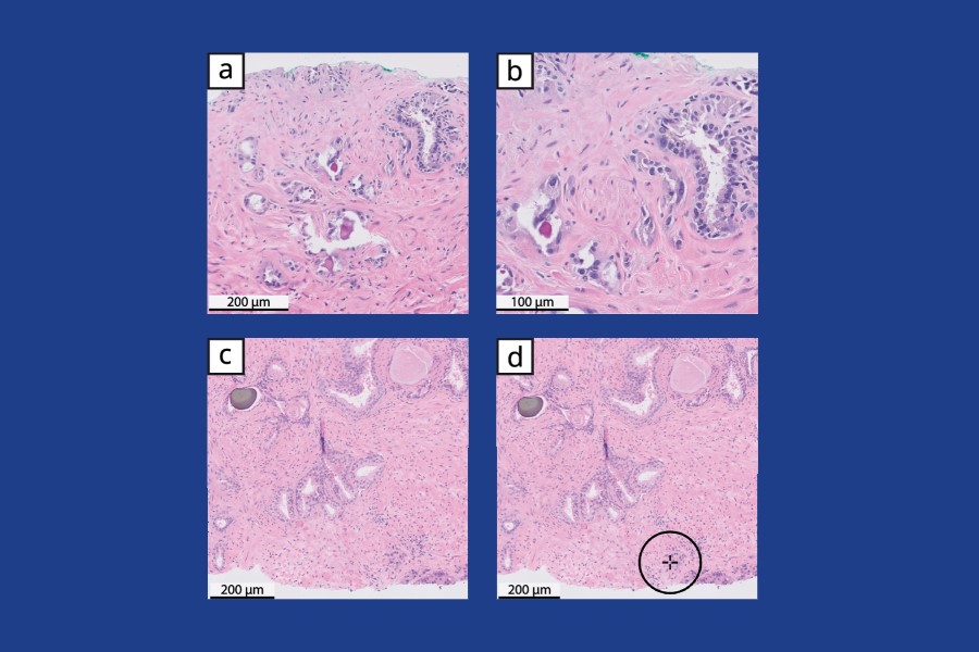 ​Published data from Paige shows increased accuracy of AI for digital pathology