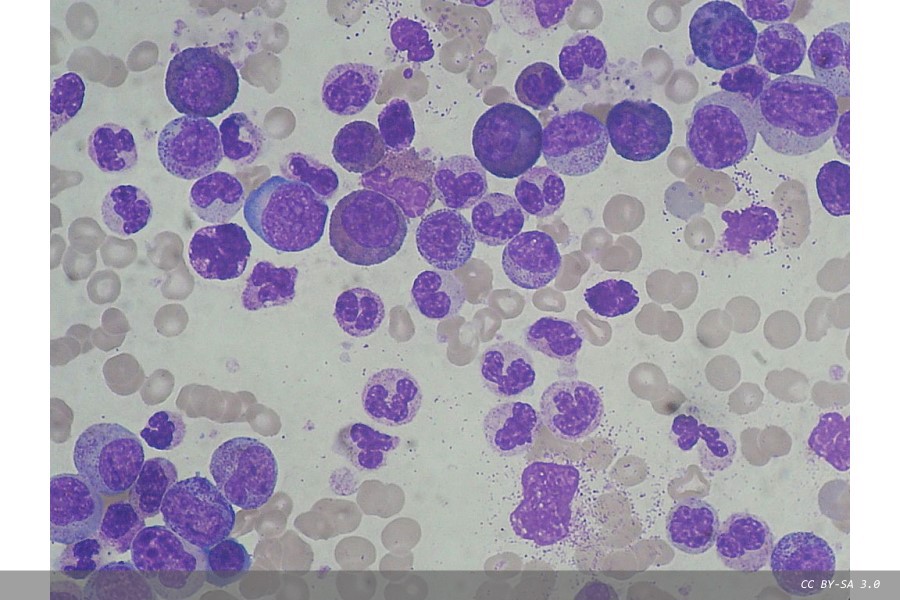Major funding boost for cutting-edge leukaemia research