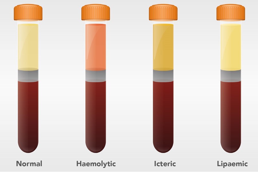 Pre-analytical errors: how to detect and interpret HIL interference