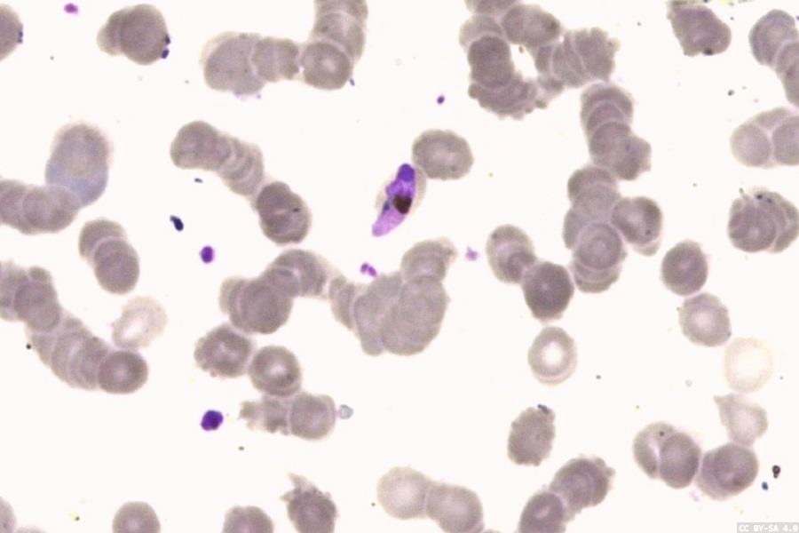New microscope using AI can detect malaria in returning travellers