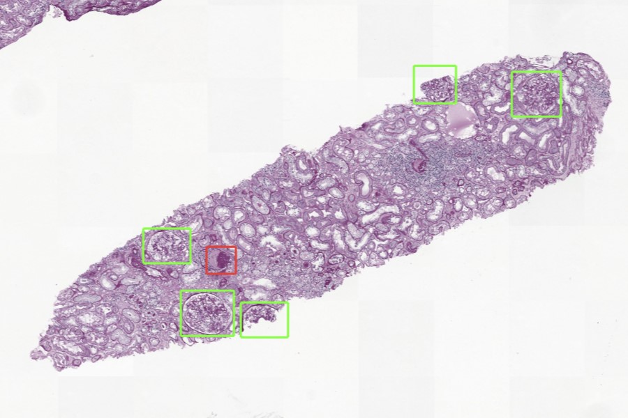 Aiosyn introduces kidney AI platform for renal disease research