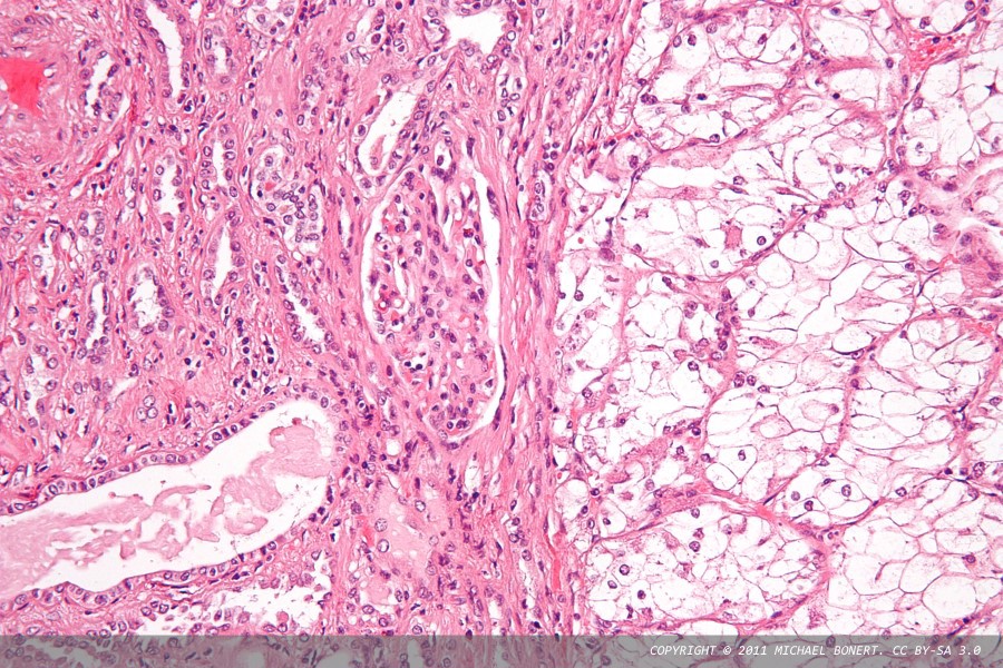 Deep learning reveals valuable clues about kidney cancer in pathology slides