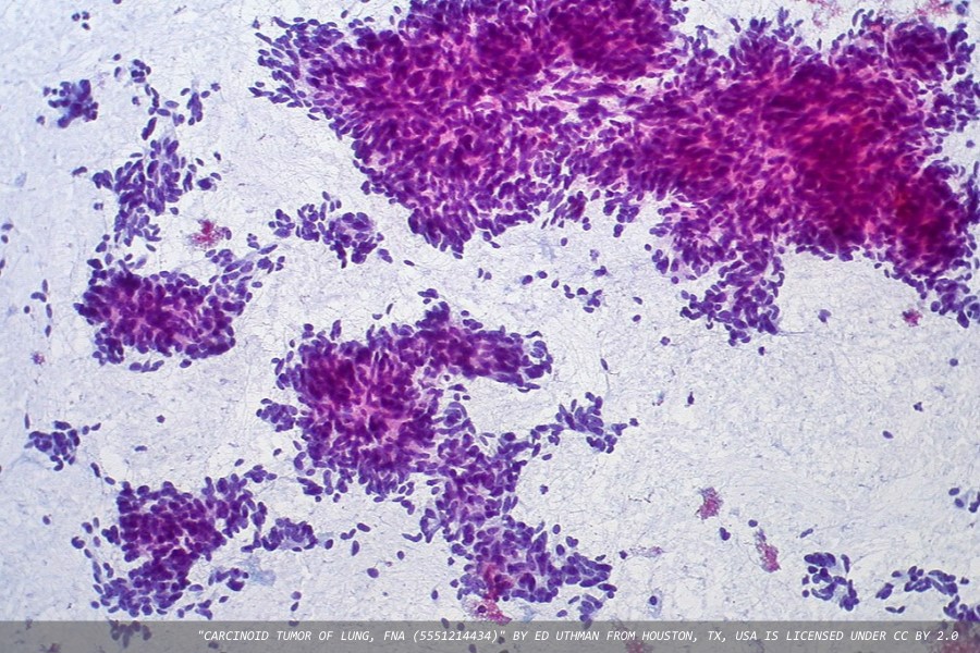 A new dataset for tumours of the lung