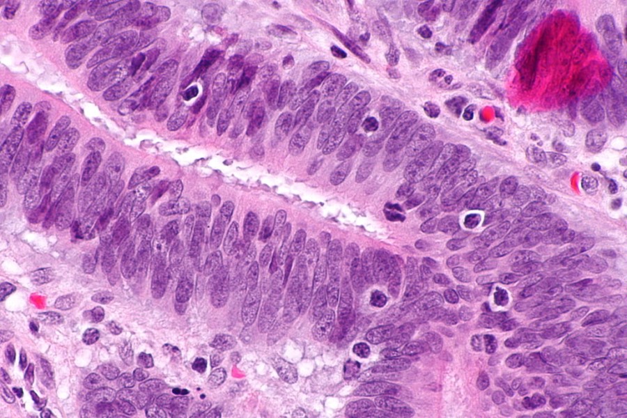 Thousands with a genetic condition offered NHS bowel cancer screening