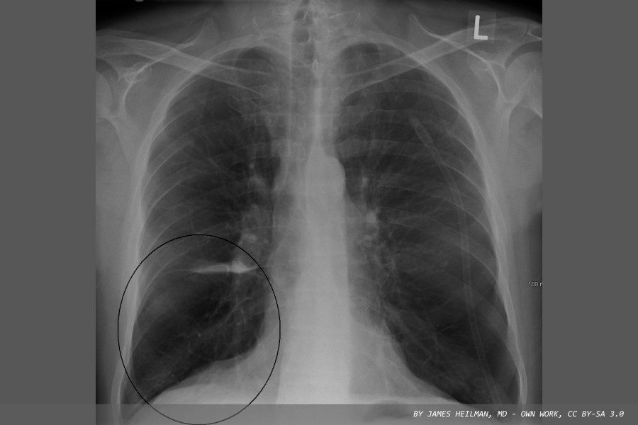 Experimental blood test predicts COPD risk