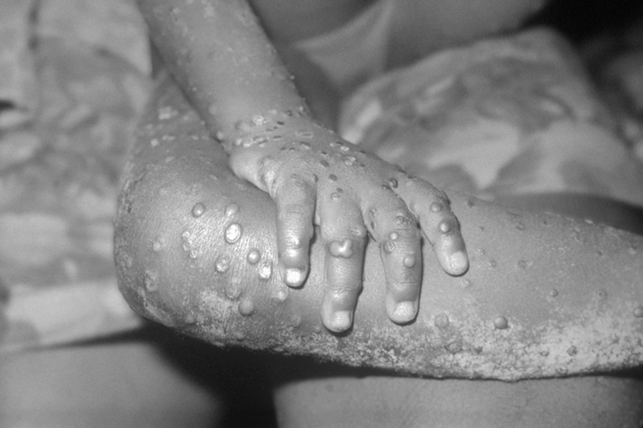 UK invests £5.5 million to tackle mpox in sub-Saharan Africa