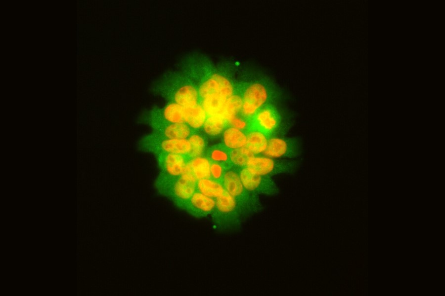 Genomic test predicts bowel cancer risk in people with IBD
