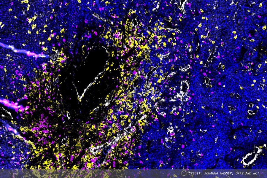New insight into spread of multiple myeloma