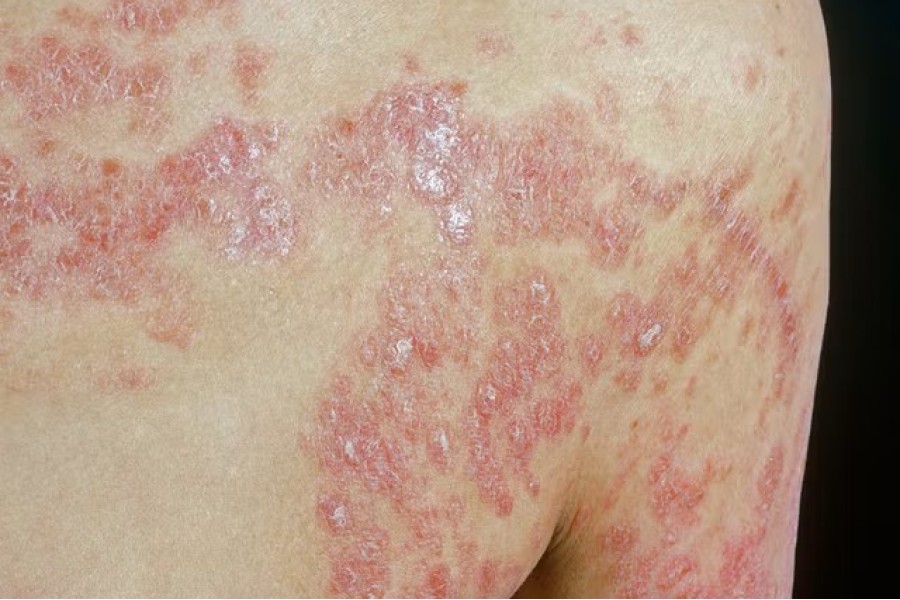 RNA technology enables novel inflammatory skin disease diagnostics