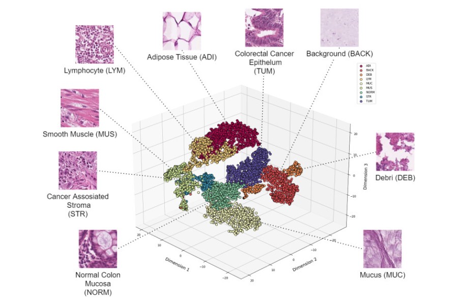 New AI tool for colorectal cancer tissue analysis offers increased accuracy
