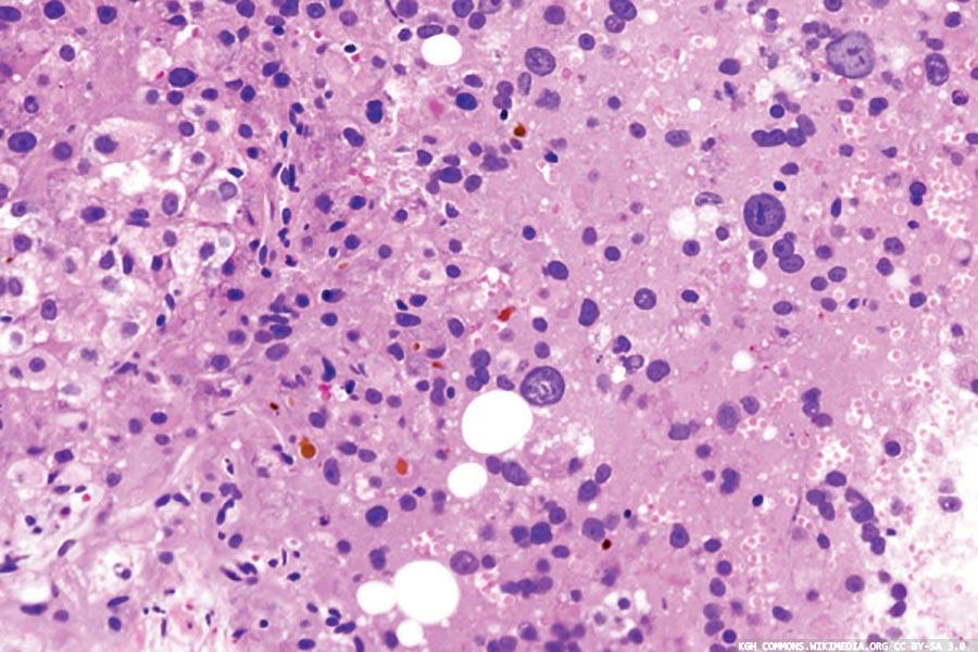 Whole genome sequencing service tackling hepatitis C