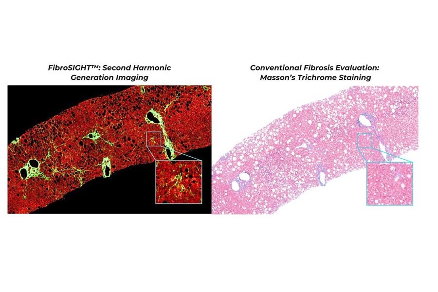 Novel LDT to assess liver fibrosis