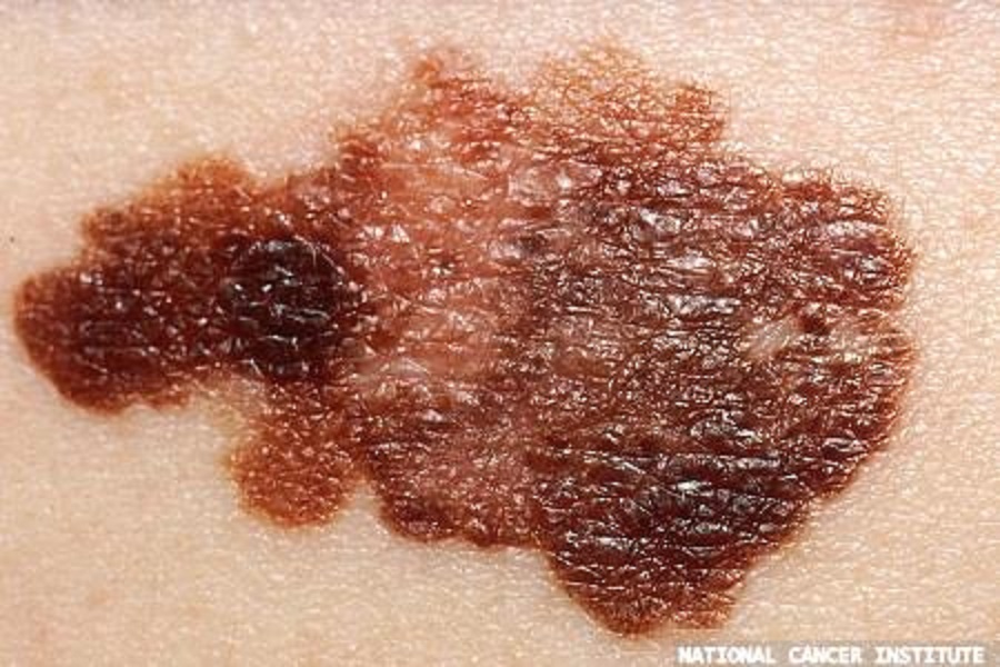 NHS expands trial of skin cancer vaccine