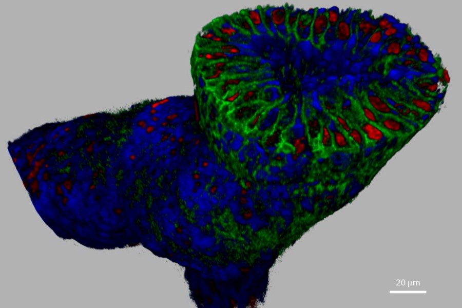 3D pathology results in more precise breast cancer treatment