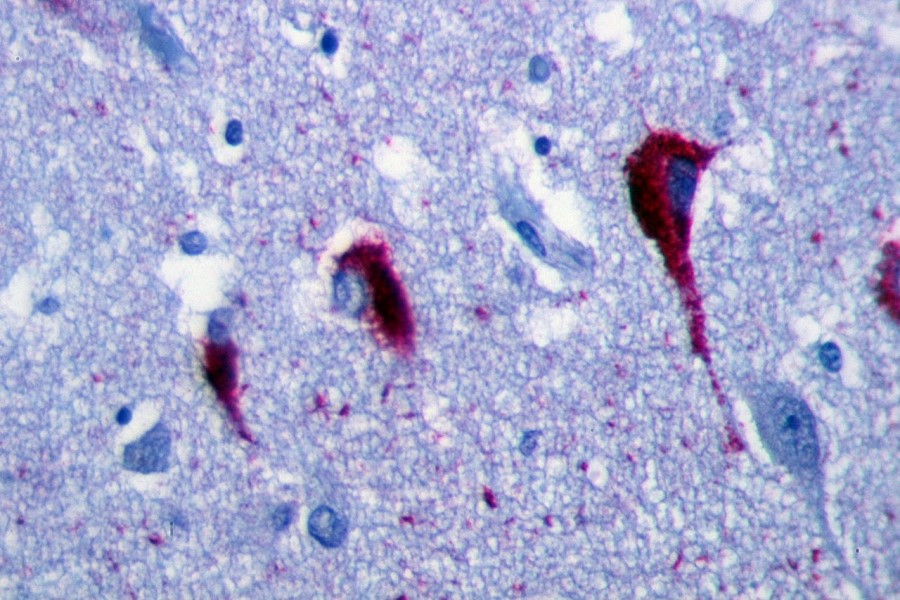 ARUP launches pTau 217 blood test to detect Alzheimer's