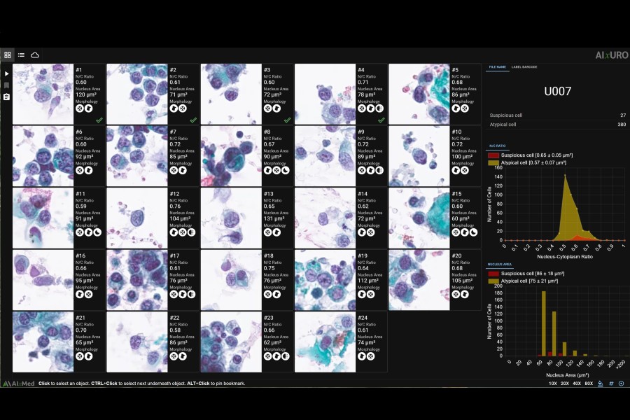 AI solution enhances bladder cancer detection