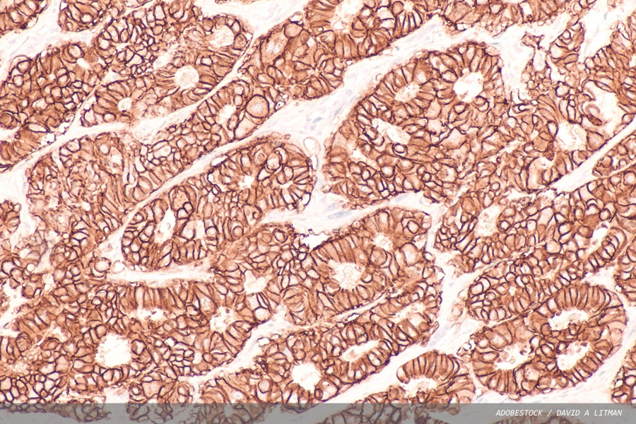 Improving HER2 classification with molecular testing