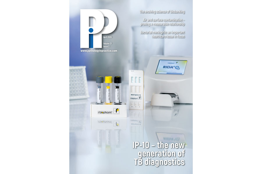 COVER STORY: Tuberculosis diagnostics - a new biomarker, a new generation